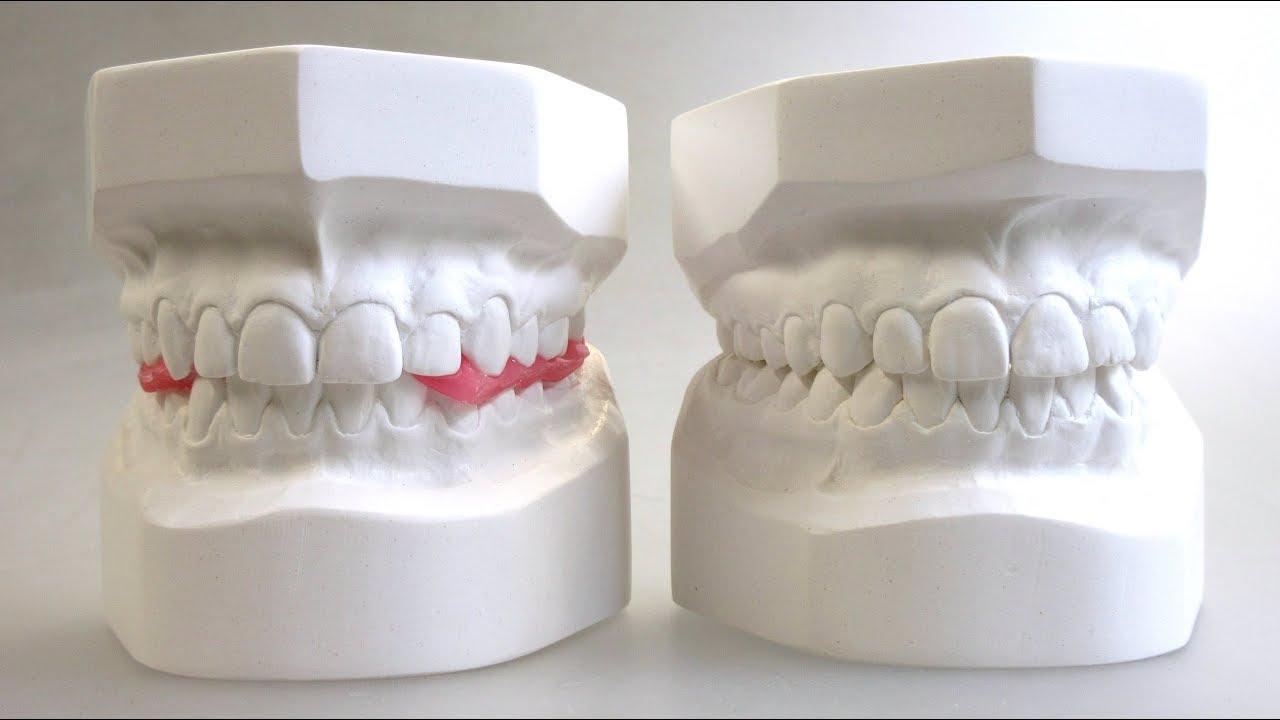 Diagnostik-Modelle KFO Trimmen, Orthodontic Study Models Trimming