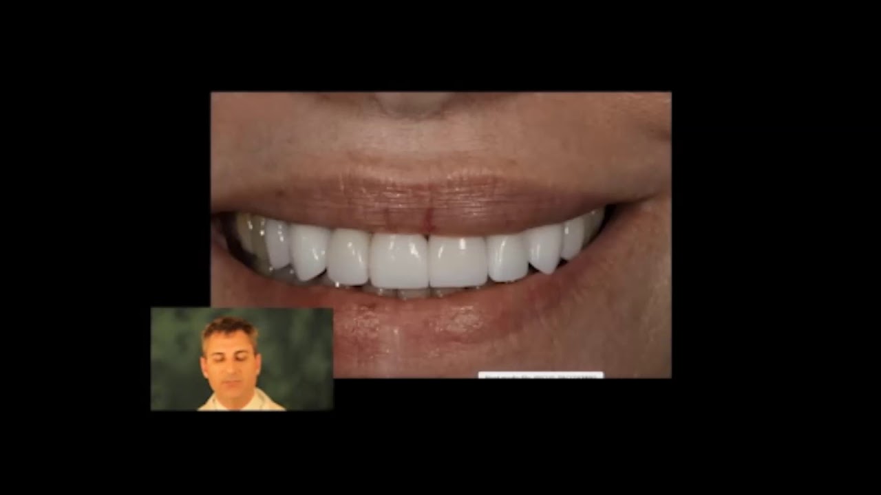 Closing Teeth Gaps with 8 Porcelain Veneers