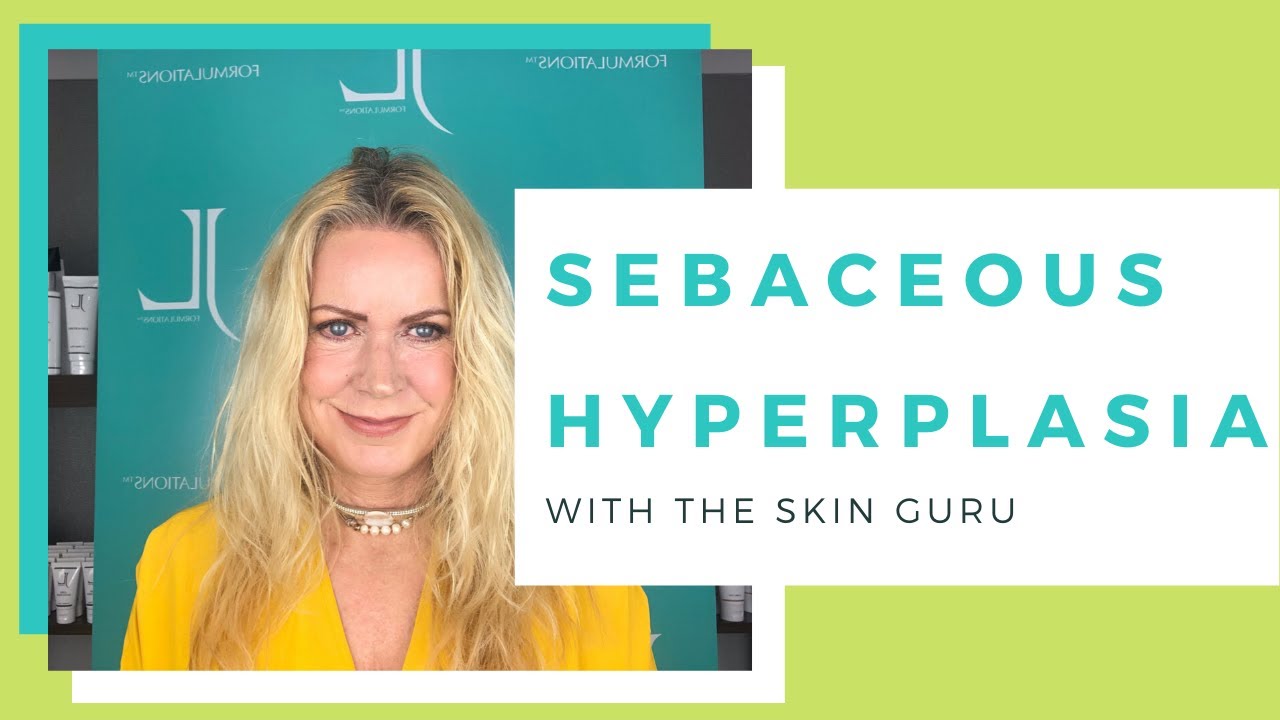 SEBACEOUS HYPERPLASIA  | BLOCKED PORES | HOW TO TREAT SEBACEOUS HYPERPLASIA