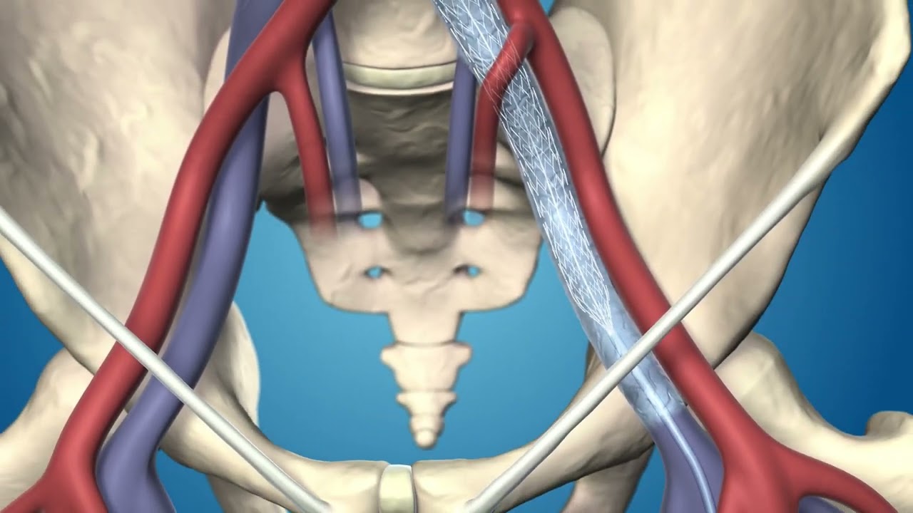 Medtronic's Abre&trade; Venous Self-Expanding Stent System product animation