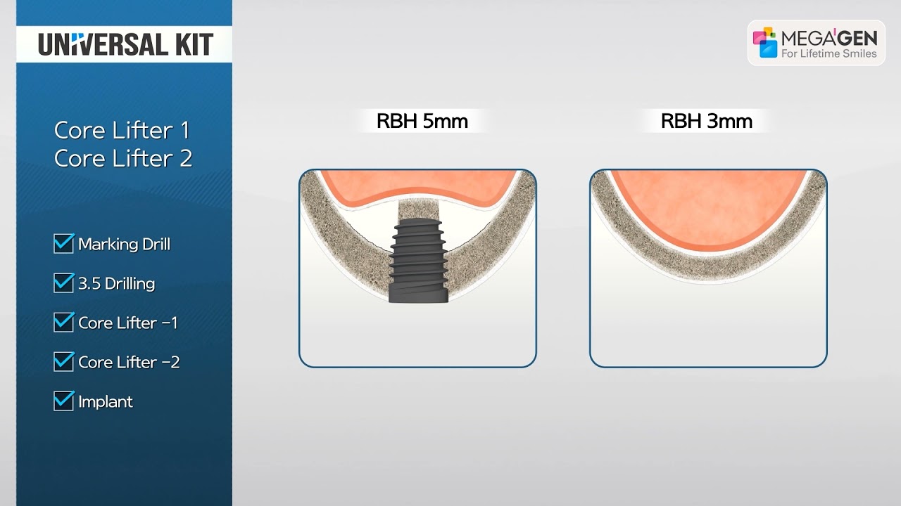 Dr  Jeon's Universal Kit Animation Core Lifter 1& 2