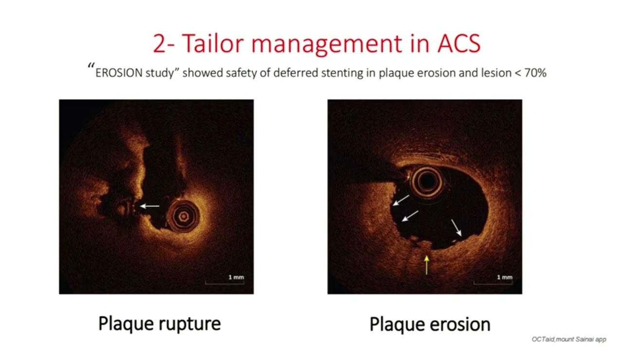 Coronary OCT summary