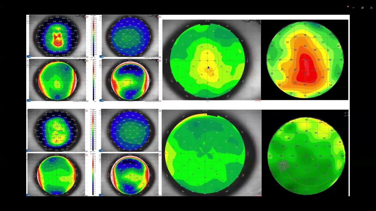 HQ - Dr. Moreno - Dr. Bernal Importancia de la medida del epitelio corneal en SmartSurface