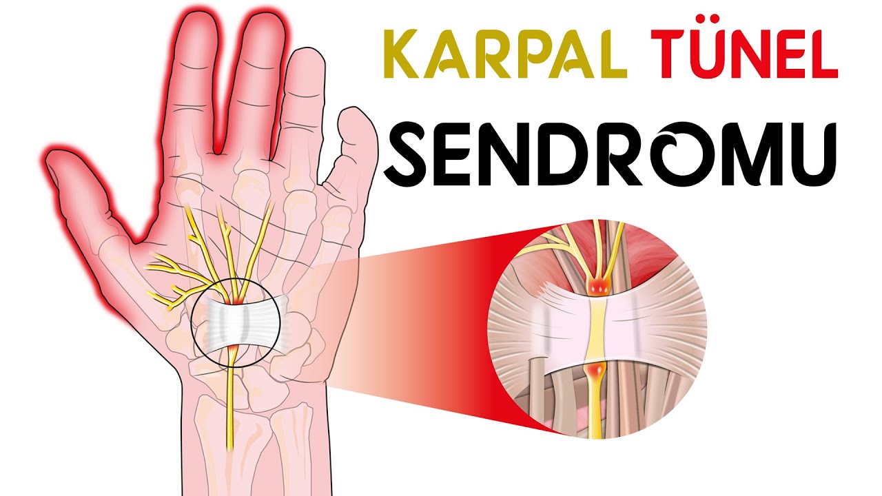 Karpal Tünel Sendromu: Belirtileri, Nedenleri ve Tedavi Yöntemleri | Prof. Dr. Yakup YILDIRIM