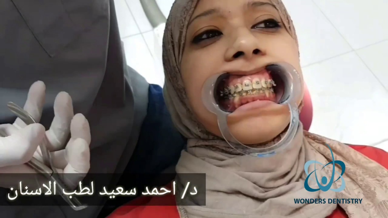 هل فك تقويم الاسنان مؤلم؟ عيادة wonders لطب الاسنان بمدينة العبور