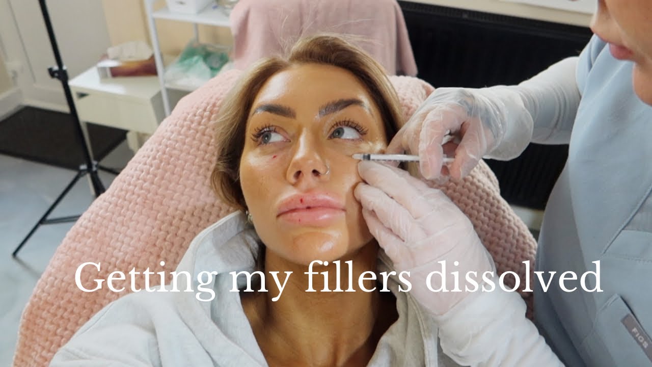 I HAD MY LIP FILLER DISSOLVED | HYALURONIDASE | BEFORE & AFTER