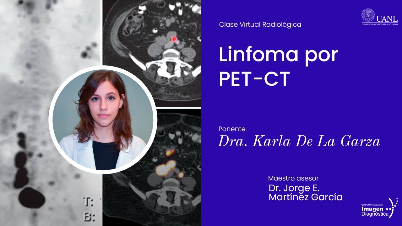 Linfoma por PET-CT por la Dra. Karla Reyna De La Garza