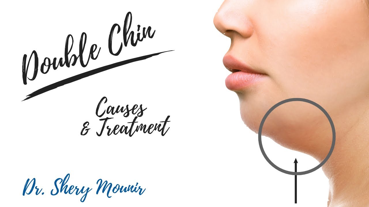 Double chin, Causes & Treatment  /  اسباب الذقن المزدوجة و طرق علاجها