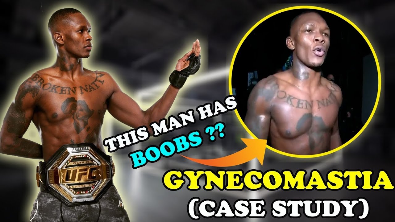 GYNECOMASTIA CASE STUDY: Why do Men develop GYNO ??