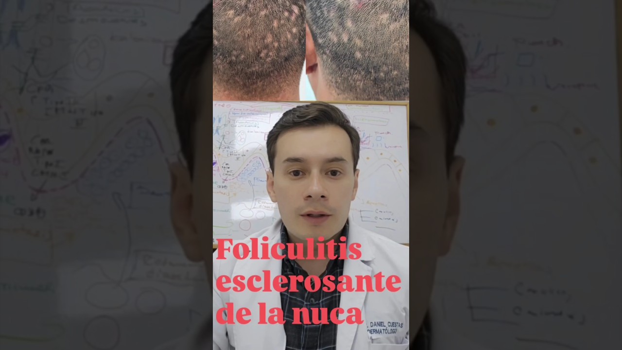 Ten cuidado con este tipo de perdida de pelo conoce la foliculitis esclerosante o acn&eacute; queloideo
