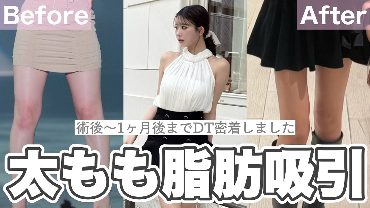 【マイナス◯cm】下半身デブと呼ばれた女が太もも脂肪吸引をした1ヶ月間のダウンタイムをお見せします👊