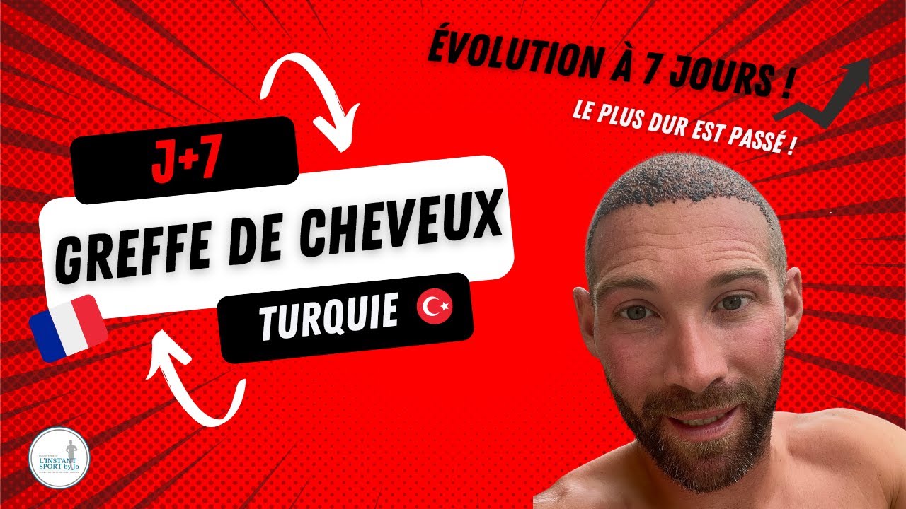 🇫🇷Greffe cheveux Turquie🇹🇷07/08/2022 épisode 5: bilan à 7 jours