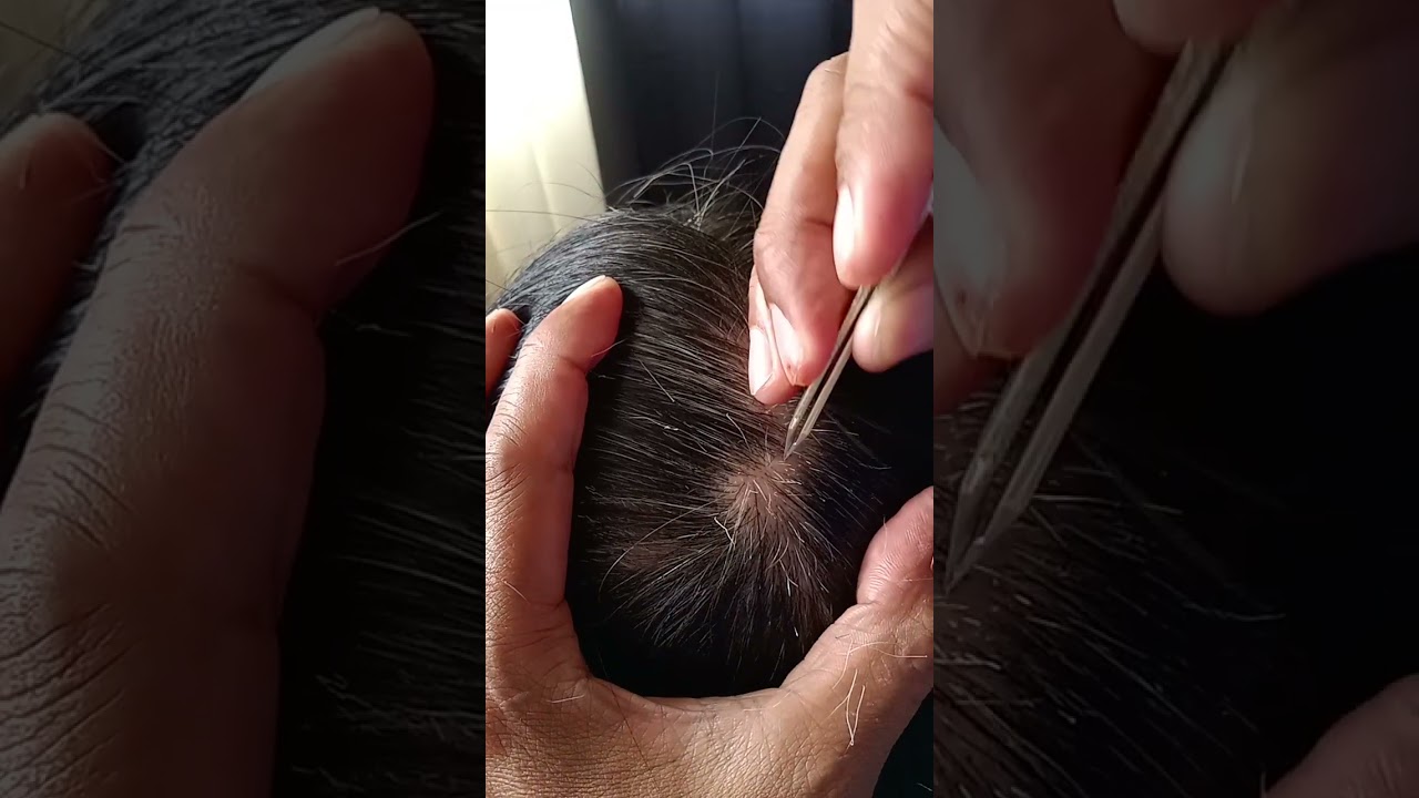 most satisfying White hair removal 0.66#satisfying #stressremoval #relaxing