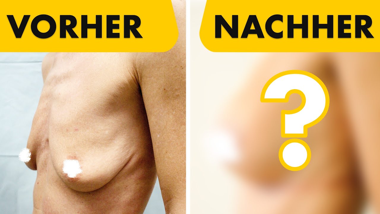Bruststraffung und Brustvergrößerung in einer OP! Vorher Nachher Vergleich | Dr. Jungwirth