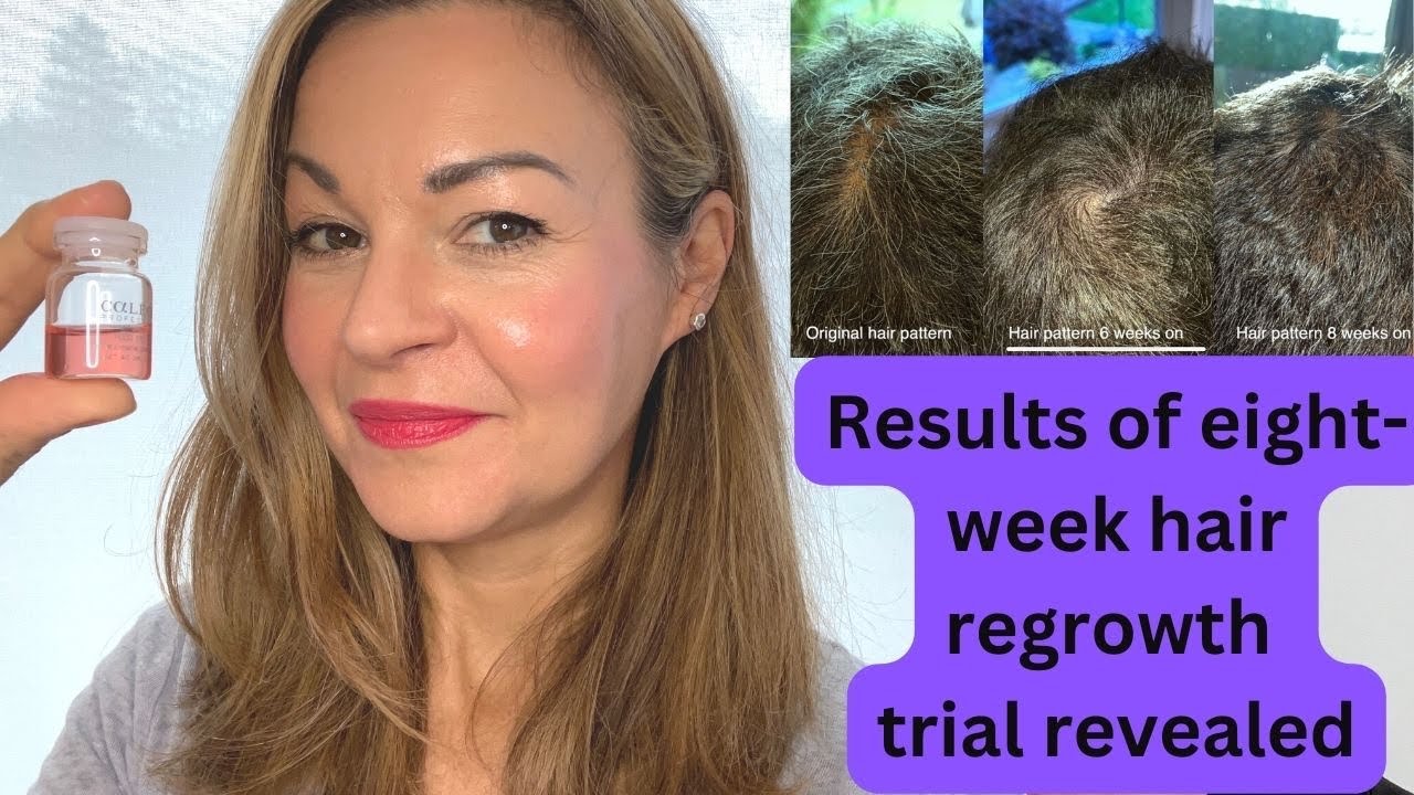 My Husband's 8-Week Results Using Calecim Professional Hair System | Review
