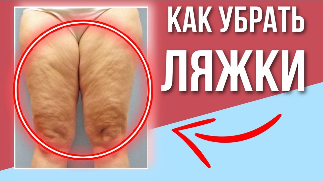 Всё про ПОХУДЕНИЕ в НОГАХ | Обвисшая внутренняя часть бедра, жир на ляжках и валики над коленями