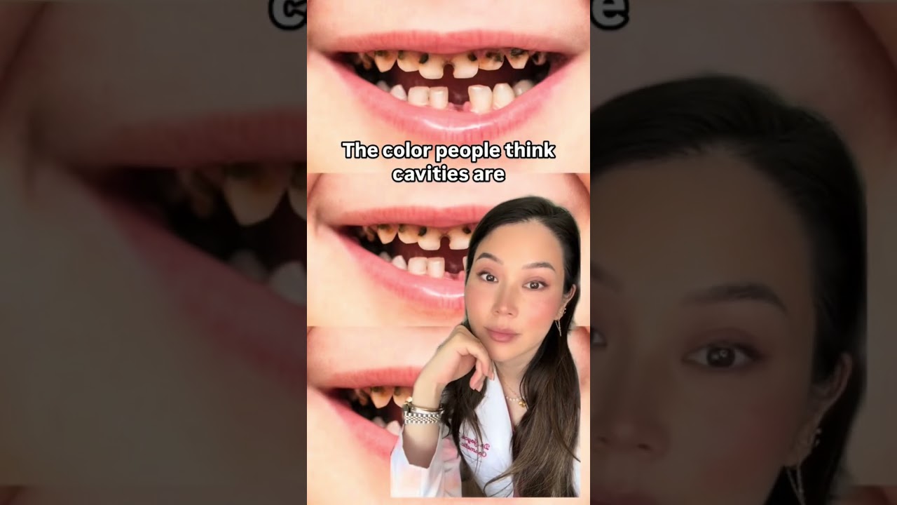 What a cavity actually looks like. 