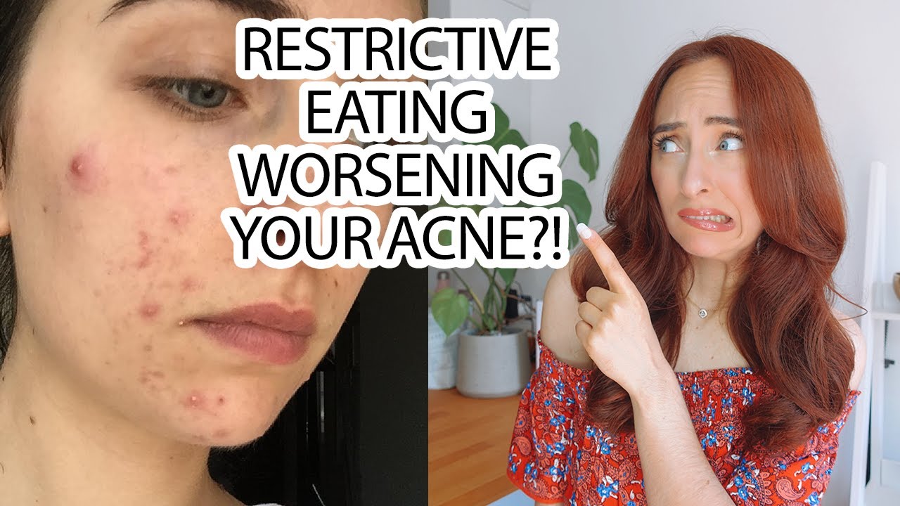 Restricting Eating Caused By Acne // REAL TALK