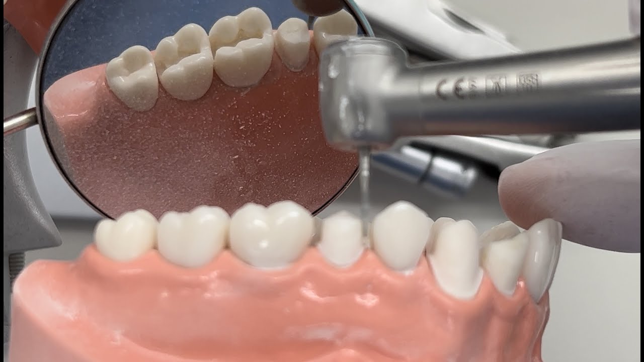 FPD Tooth Preparation (Initial Reduction) #25