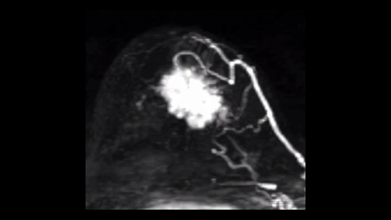 Breast DCE Perfusion MRI study
