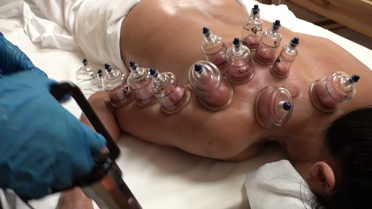 Sports Massage Combined with Cupping Therapy