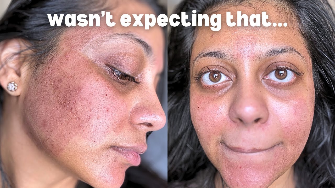 Pigmentation Treatment On Face | CO2 Fractional Laser