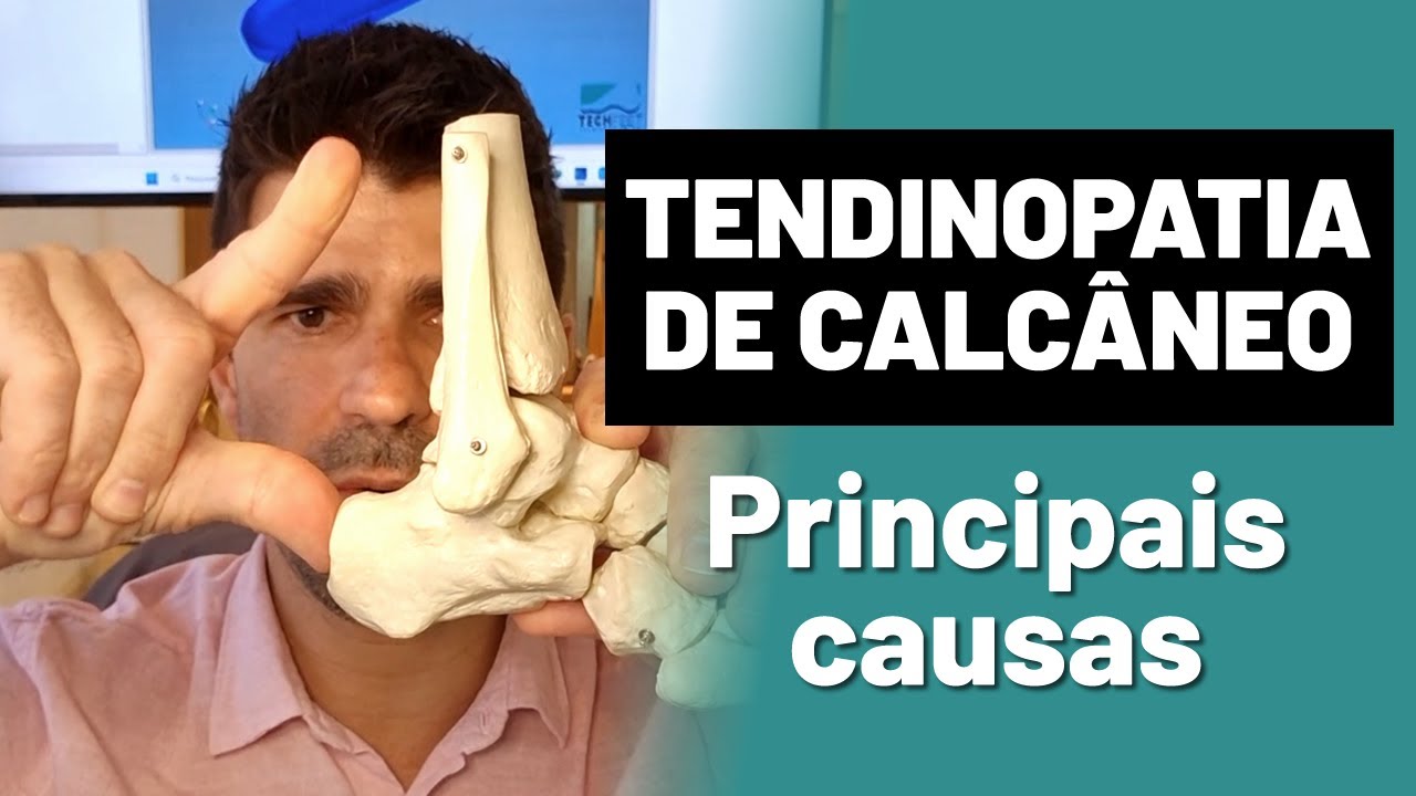 Tendinopatia de Calcâneo