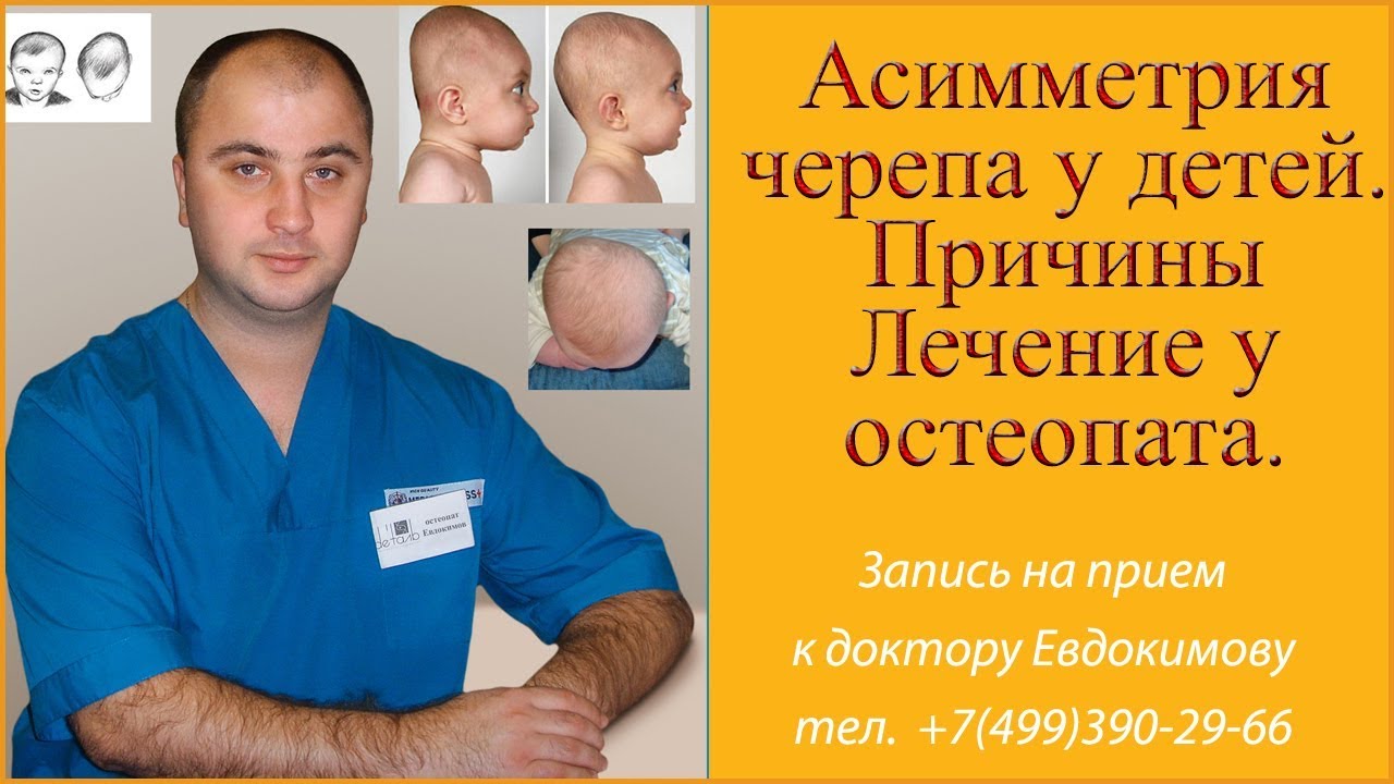Асимметрия головы у ребенка. Причины.  Лечение остеопатией