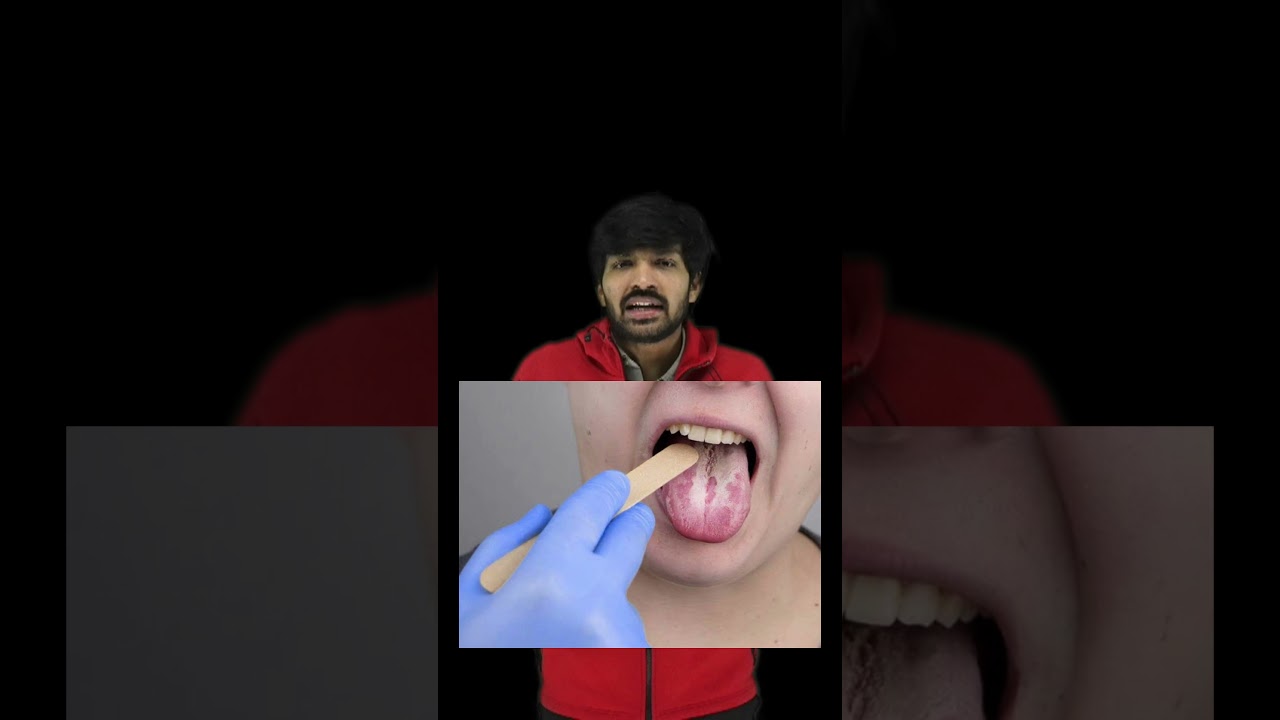 Oral Candidiasis vs Leukoplakia #medicaleducation