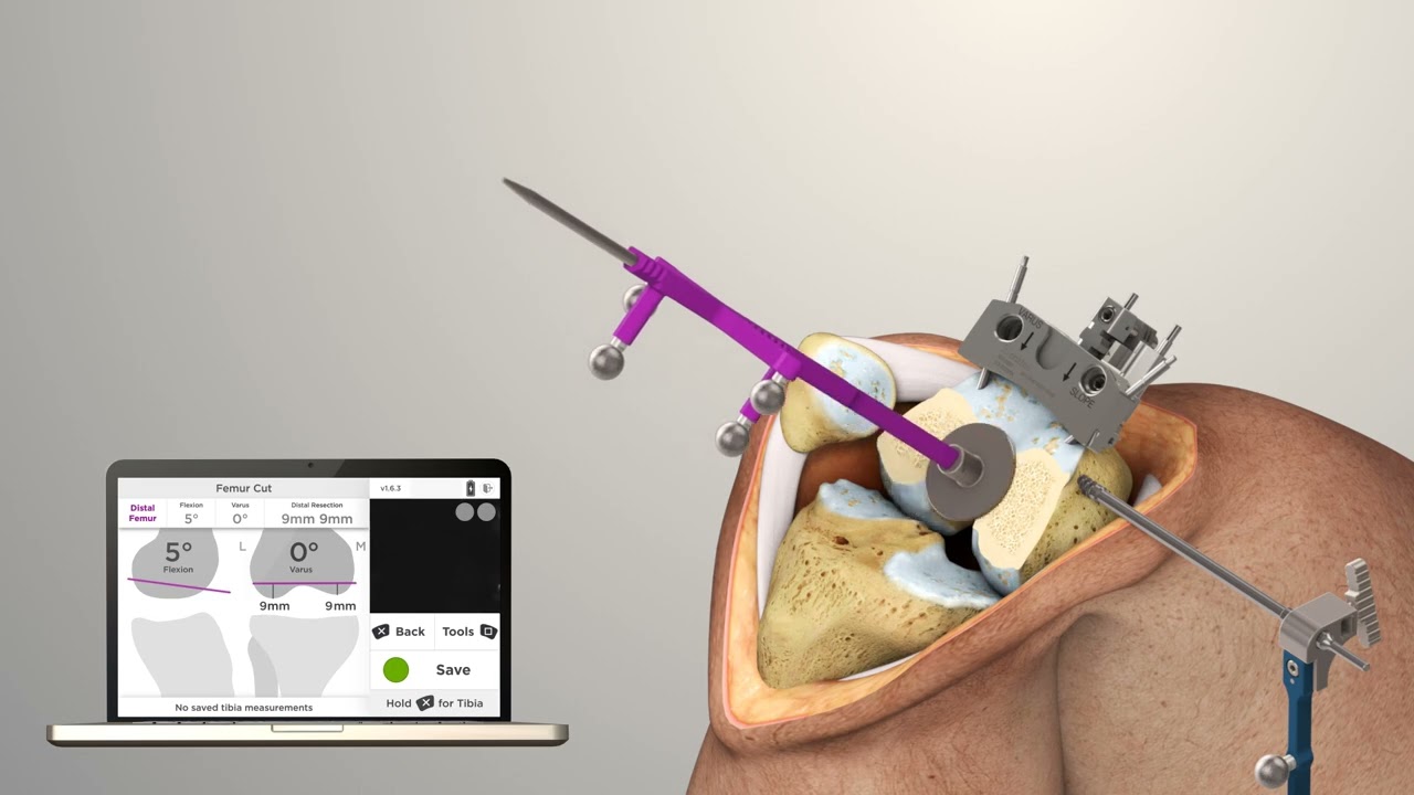 Intellijoint KNEE