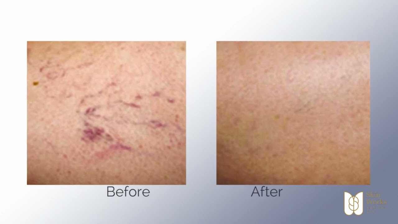 Spectrum Laser System at Skin Works at Newport beach medical surgical center