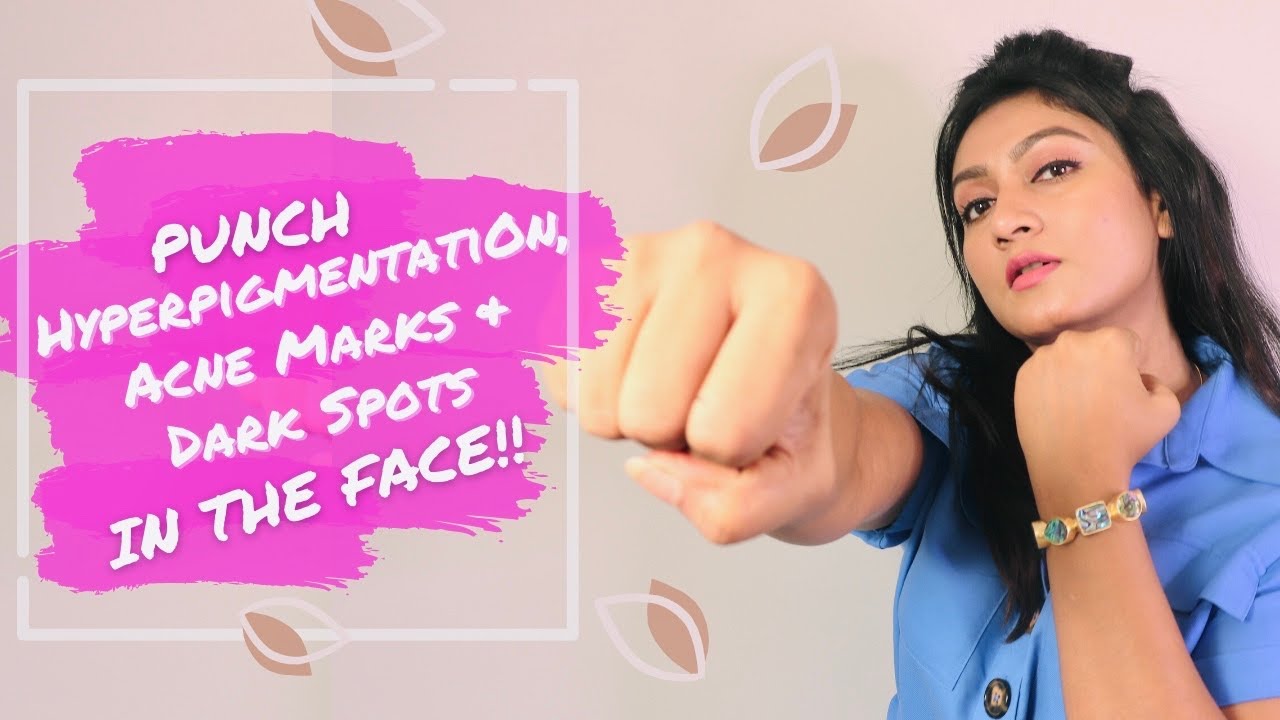 Get rid of Hyperpigmentation Dark spots Acne Marks Now! || Home remedy || Treatment || Ashtrixx