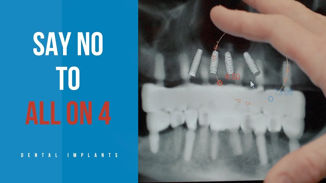 SAY NO to All on 4! I Exploring the Difference Between All-on-4 and All-on-6 Dental Implants