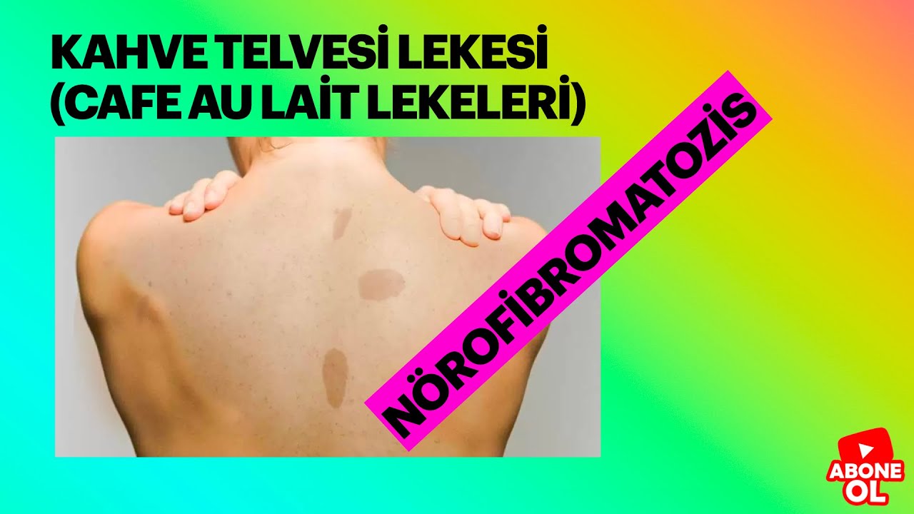 Kahve Telvesi Lekesi, Cafe au Lait Lekesi, Nörofibromatozis tip 1, Prof Dr Ahmet Demir