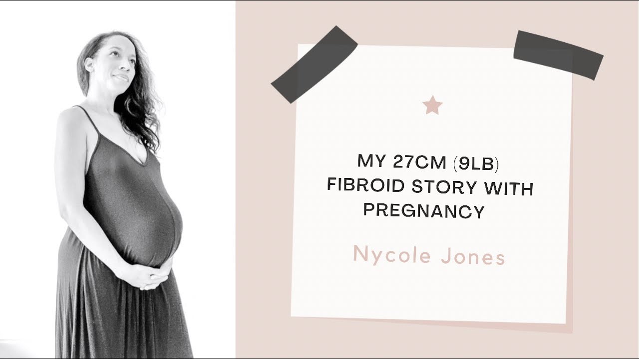 My Quick Story about my 27cm Fibroid and Pregnancy