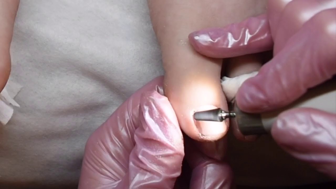 Pedicure - Damaged Toenails fixed and perfected