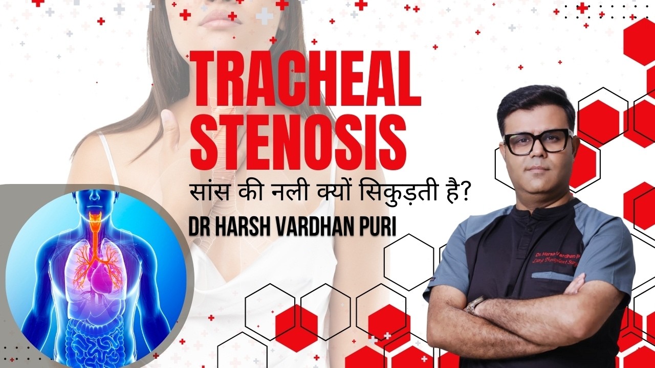 TRACHEAL STENOSIS सांस की नली क्यों सिकुड़ती है? DR HARSH VARDHAN PURI