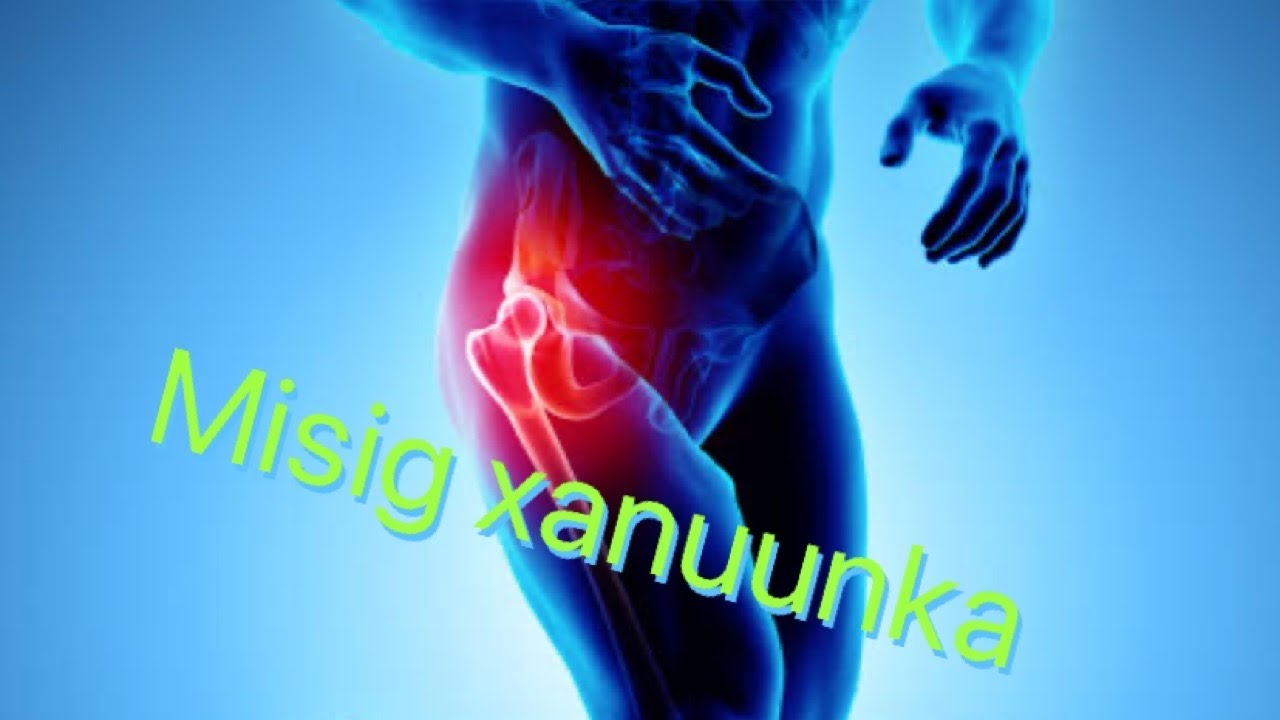 Xanuunka ku dhaca Misigta ee artaroosaha | Misig xanuunka |