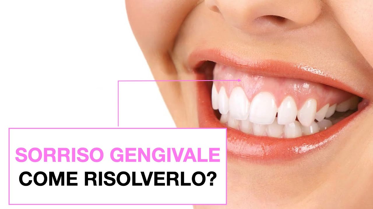 Sorriso gengivale: come risolverlo?