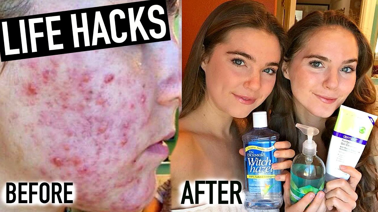 15 Life Hacks To CLEAR ACNE | NinaAndRanda