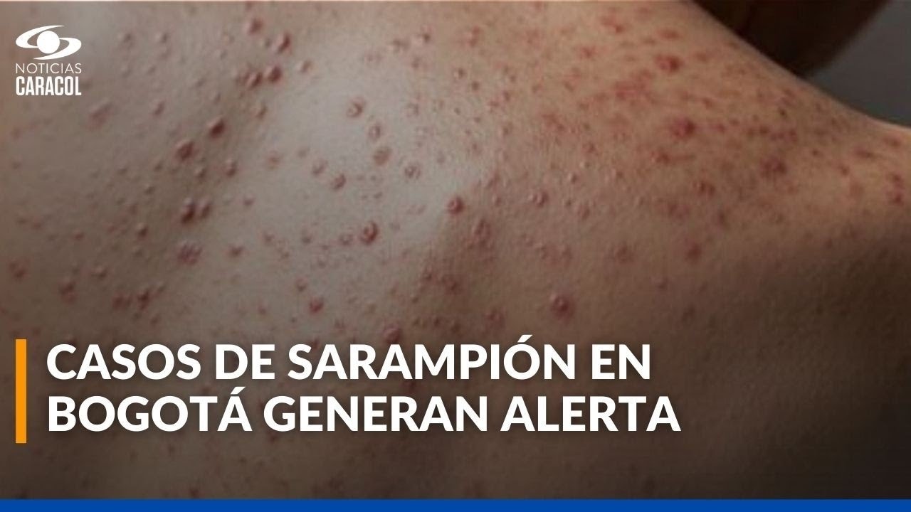 Se confirmaron tres casos de sarampión en Bogotá: protocolos de contención fueron activados