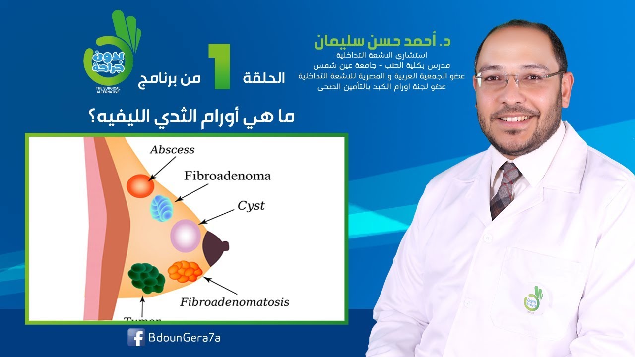 ما هي أورام الثدي الحميدة أو الخبيثة - بدون جراحة 1 | دكتور أحمد حسن سليمان
