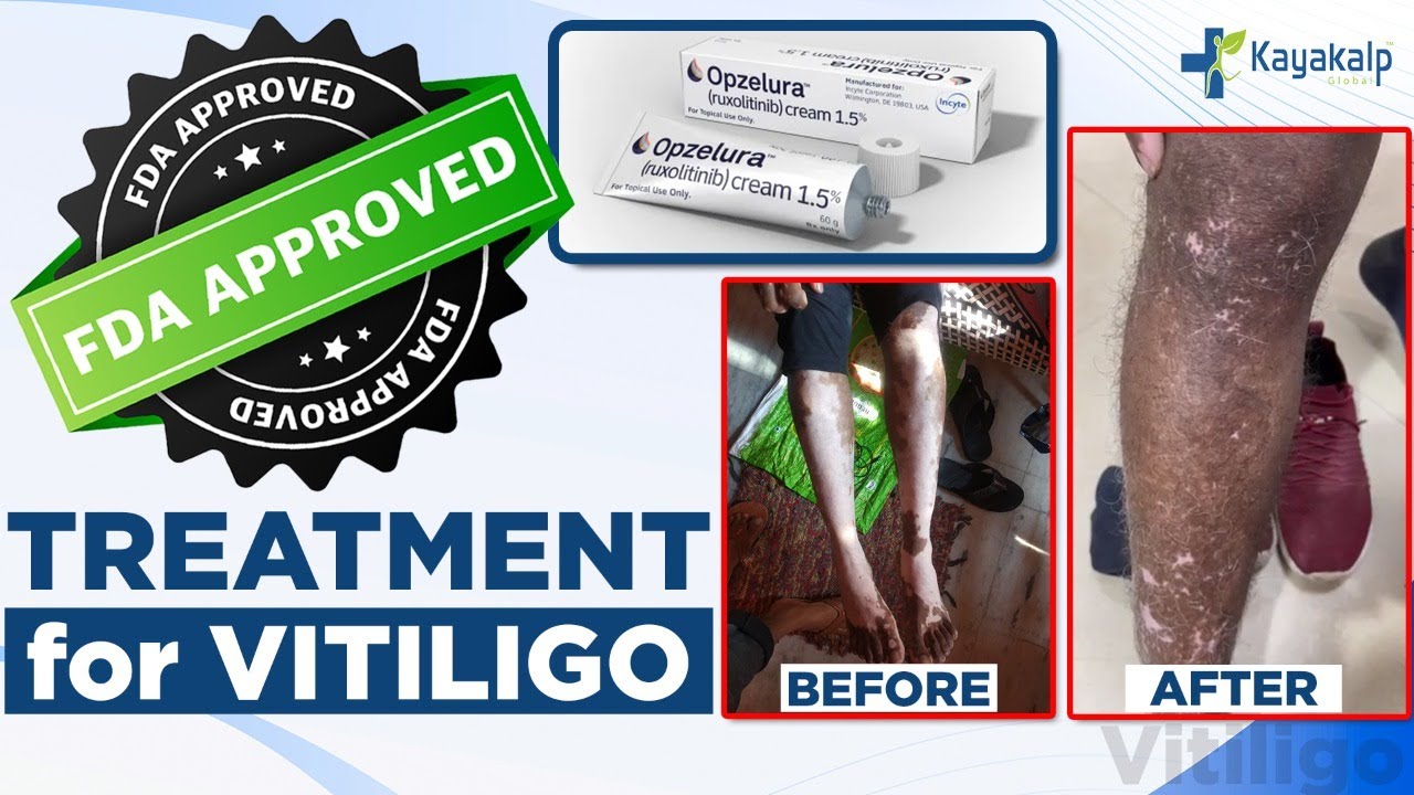 New FDA Approved Vitiligo Treatment |Opzelura For Vitiligo | Medicine for Vitiligo | Kayakalp Global