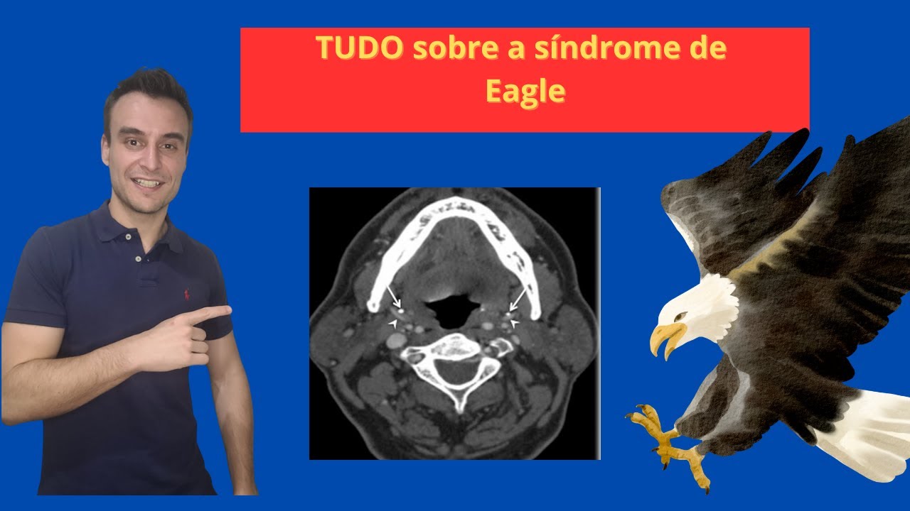O que é síndrome de Eagle? Diferença entre processo estiloide alongado e calcificado