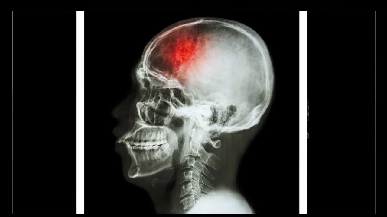 Stroke Risk Factors