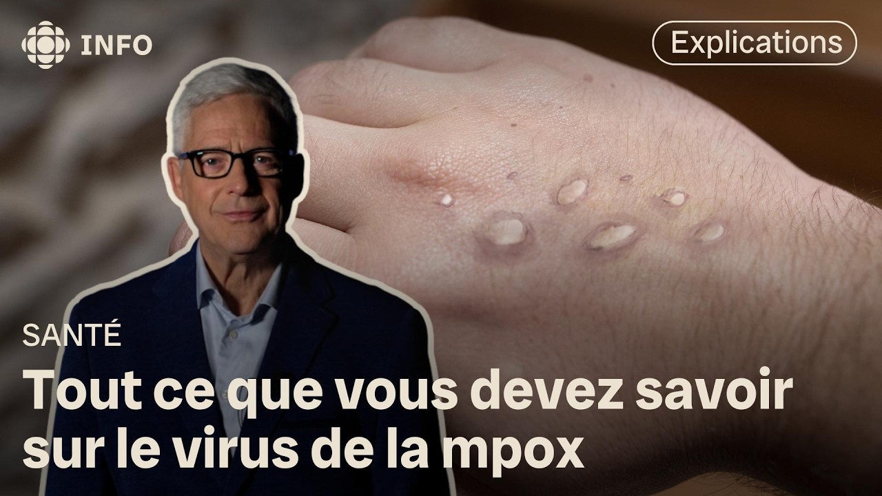 Virus mpox : c’est quoi et comment se transmet-il?