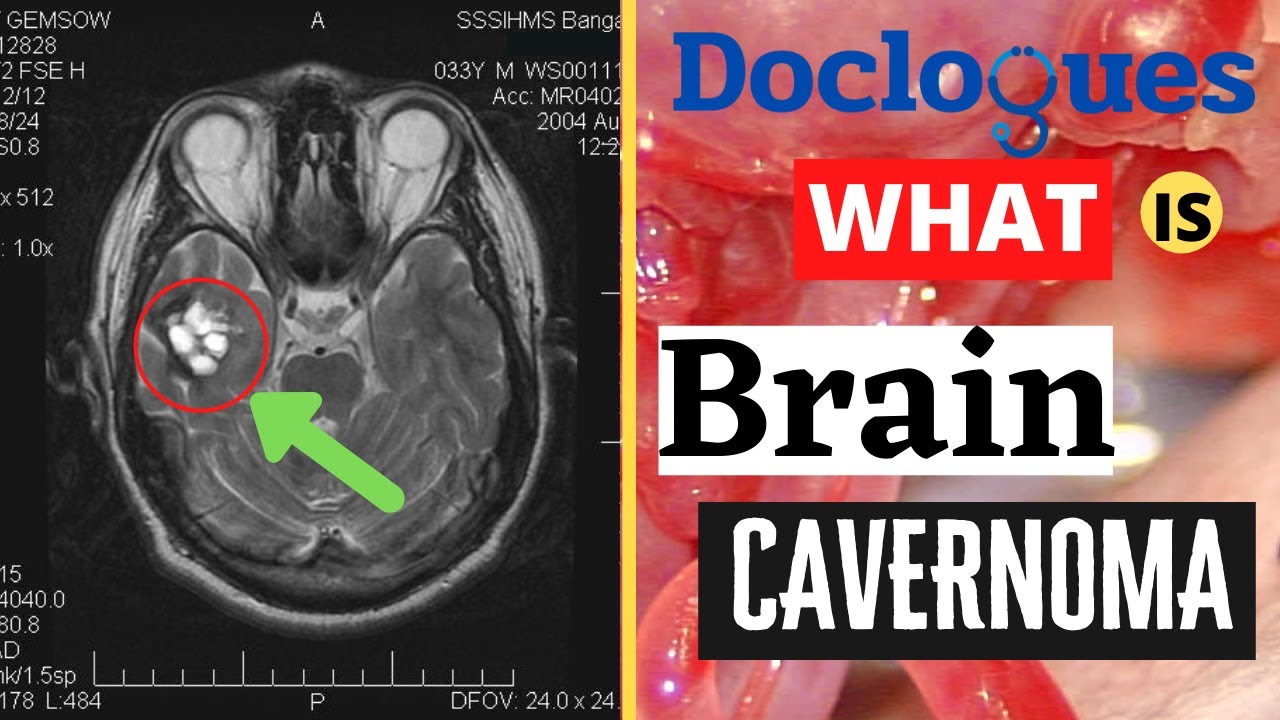 Что такое кавернома головного мозга?