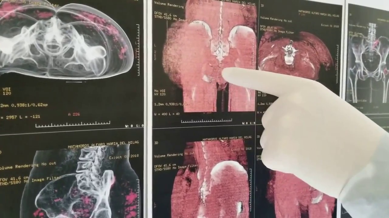 Como se ven los biopolimeros Resonancia ' tac