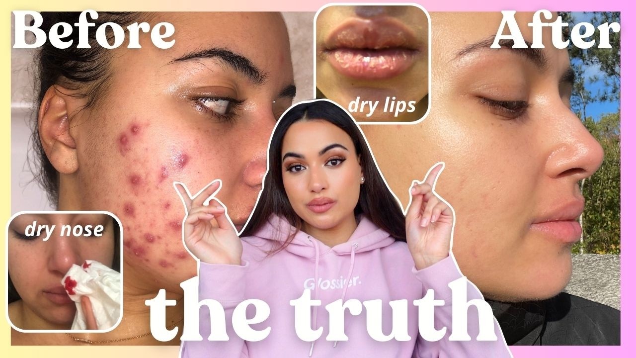 THE ULTIMATE GUIDE TO ACCUTANE FOR ACNE: Everything You Need to Know About Isotretinoin #clearskin