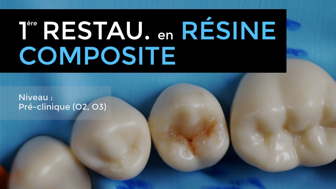 102 - Restauration occlusale en résine composite sur une prémolaire mandibulaire